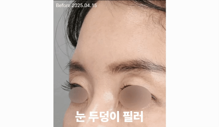 필러 부작용을 치료 잘 하는 곳의 특징 전후사진