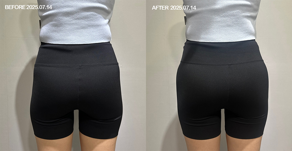 대전 힙딥 필러 전후 이미지 1