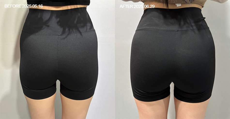 대전 힙딥 필러 전후 이미지 1