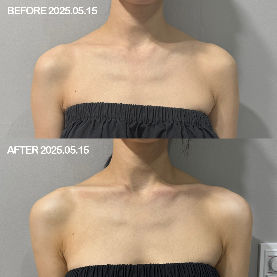대전 어깨+쇄골필러 전후 이미지 1