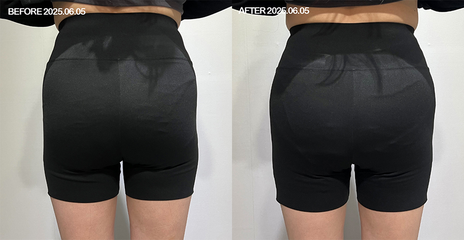 대전 힙딥 필러 전후 이미지 1