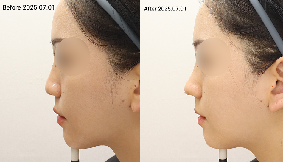 대전 코끝 미쥬코 전후 이미지 1