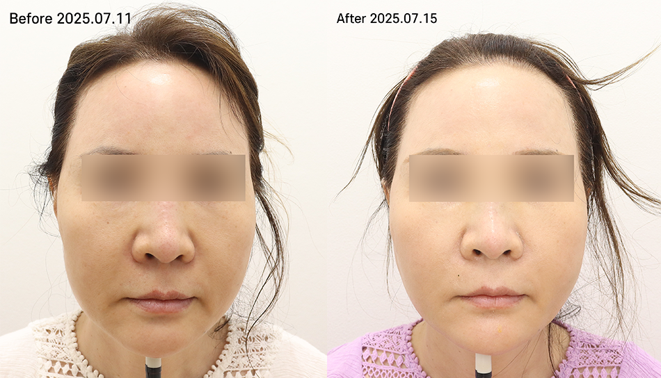 대전 원더리프트+민트픽스 전후 이미지 1