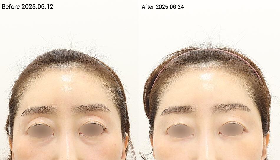 대전 눈두덩이+눈밑 필러 전후 이미지 1