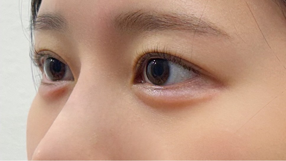 대전 애교필러 45도 전후 이미지 1