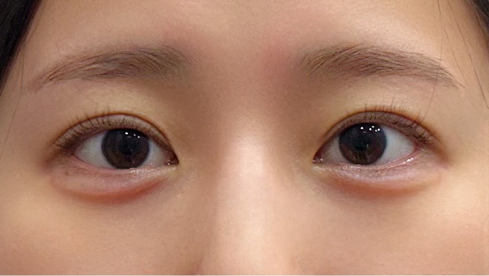 대전 애교필러 정면 전후 이미지 1