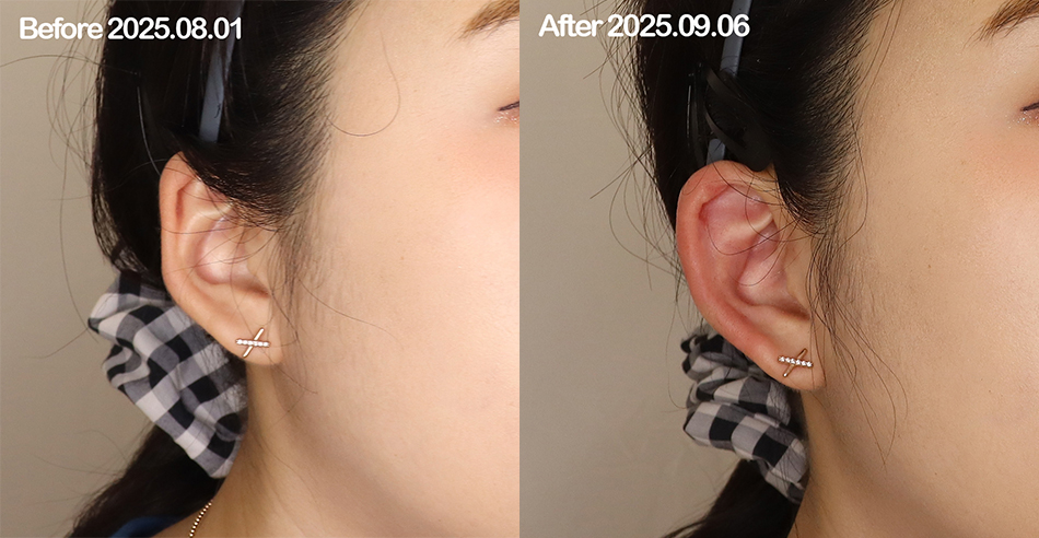 대전 엘프 귀필러 전후 이미지 1