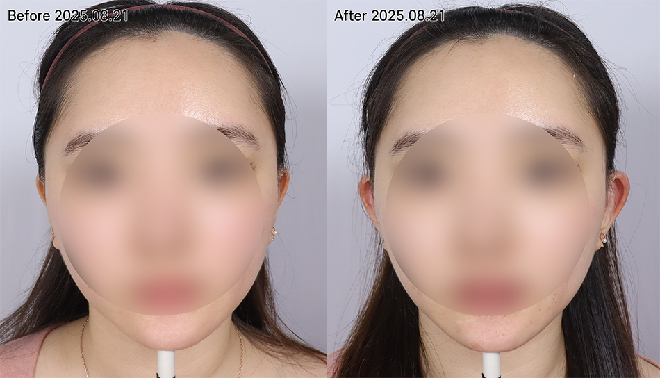 대전 엘프 귀필러 전후 이미지 1