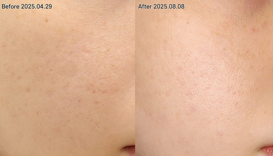 대전 흉터필러 전후 이미지 1