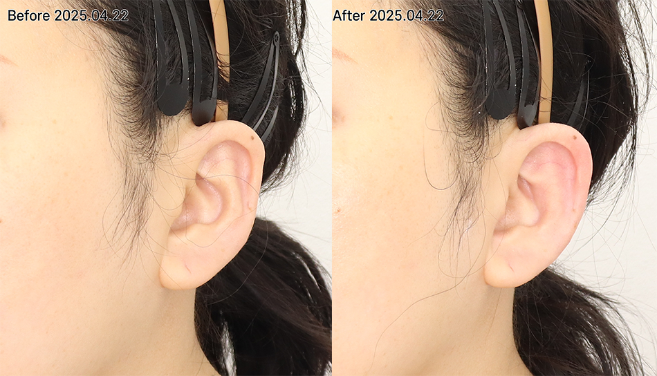 대전 엘프 귀필러 전후 이미지 1