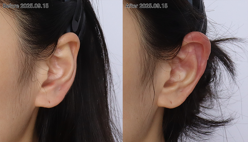 대전 엘프귀필러 전후 이미지 1