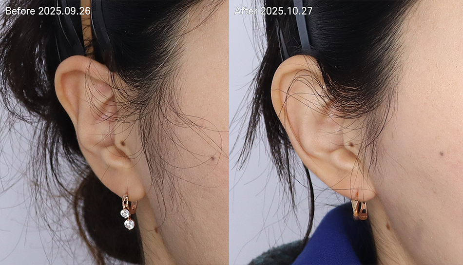 대전 엘프귀필러 전후 이미지 1