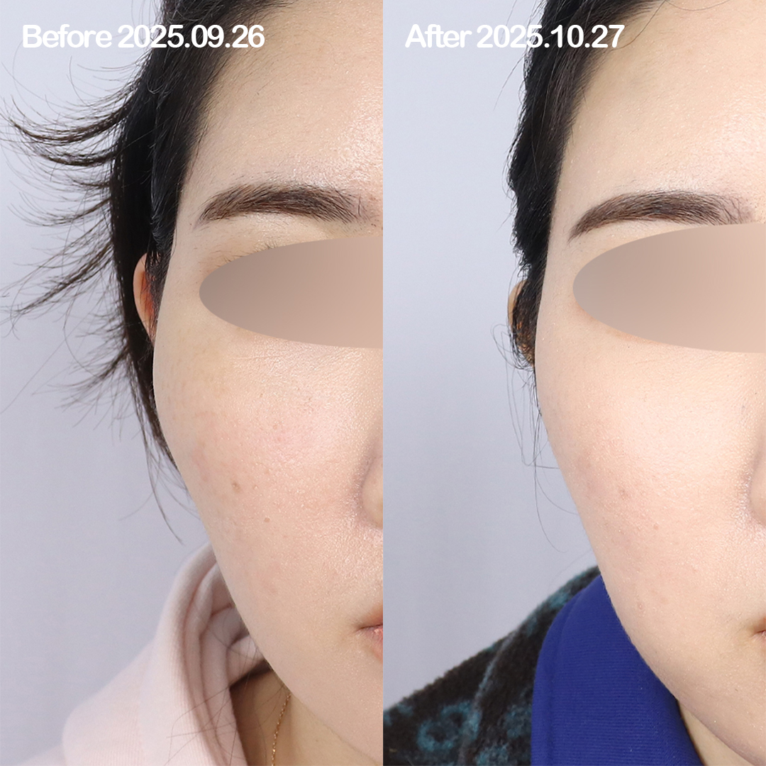 대전 비수술 안면윤곽시술 전후 이미지 1