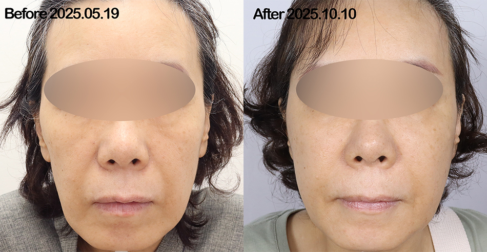 대전 BA 윤곽디자인 시술 전후 이미지 1