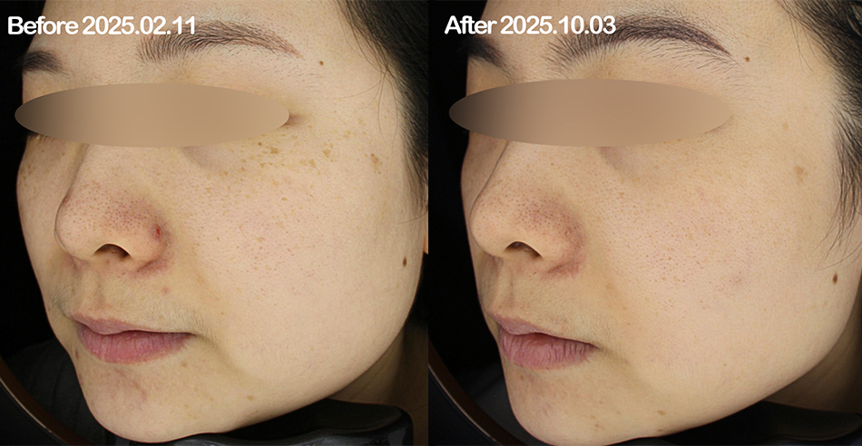 대전 피코토닝+주근깨,잡티레이저 전후 이미지 1