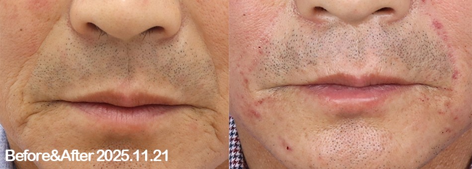 대전 즉각효과 주름필러 전후 이미지 1