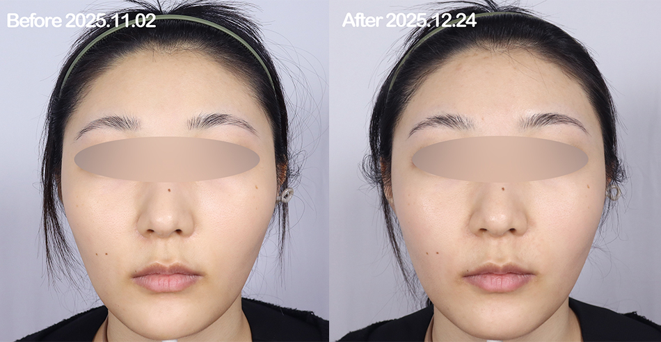 대전 튀어나온 광대라인 광대축소 패키지 전후 이미지 1