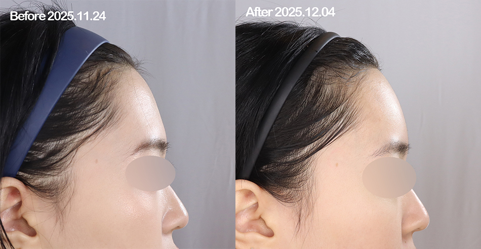 대전 이마필러 전후 이미지 1