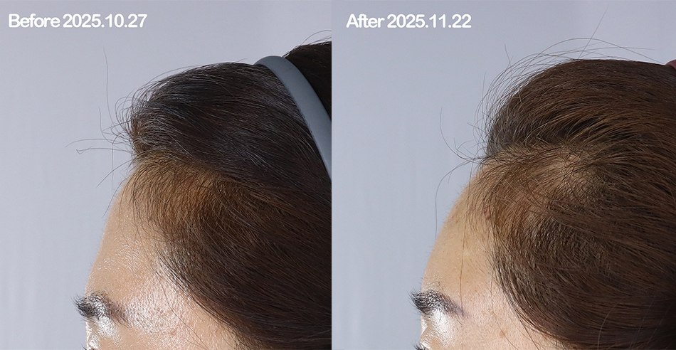 대전 이마필러 전후 이미지 1