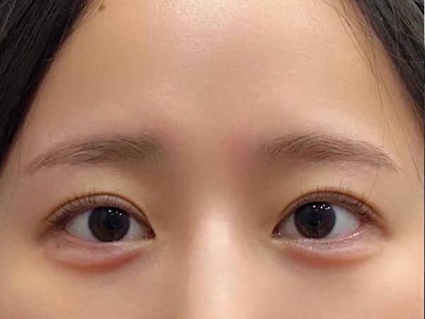 대전 애교필러 정면 전후 이미지 2