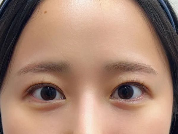 대전 애교필러 정면 전후 이미지 1