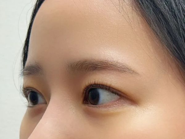 대전 애교필러 45도 전후 이미지 1