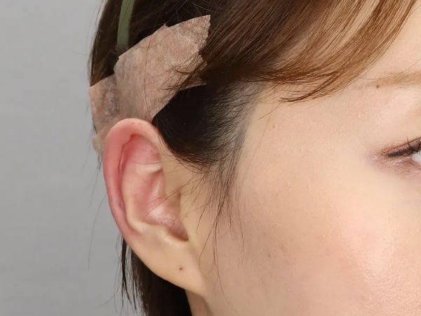 대전 엘프귀 필러 전후 이미지 2