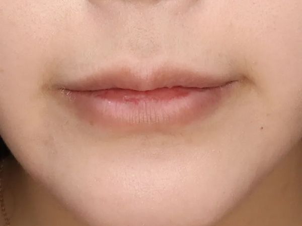 대전 말린 입술 입술필러 전후 이미지 1