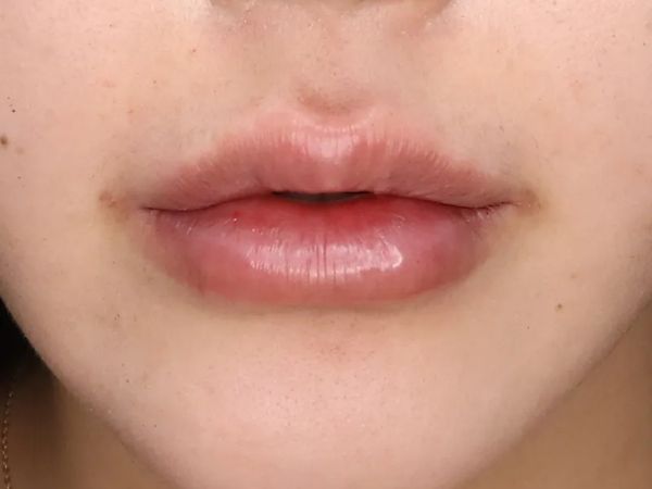 대전 말린 입술 입술필러 전후 이미지 2