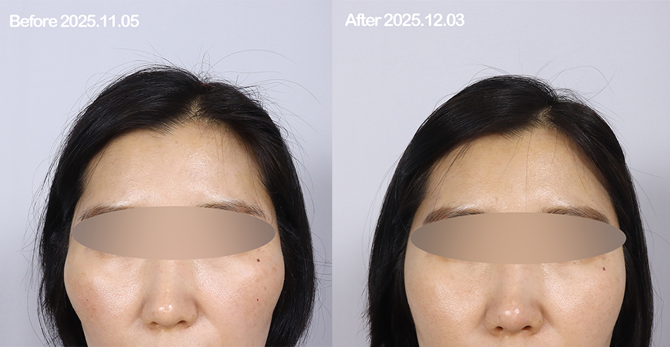 대전 광대 축소 주사 전후 이미지 1