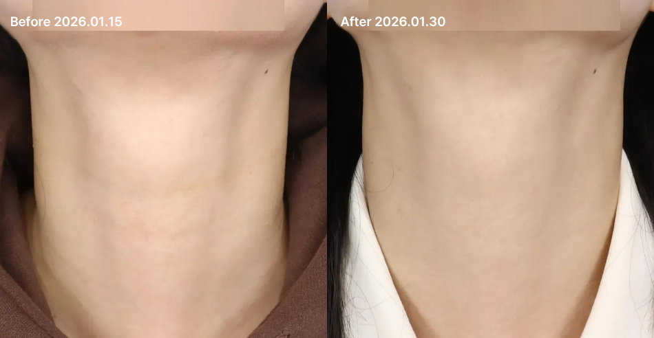 대전 목주름필러 전후 이미지 1