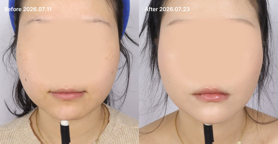 대전 턱끝 필러 1