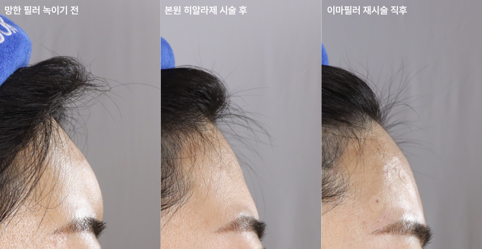 대전 망한 이마필러 재건 전후 이미지 1